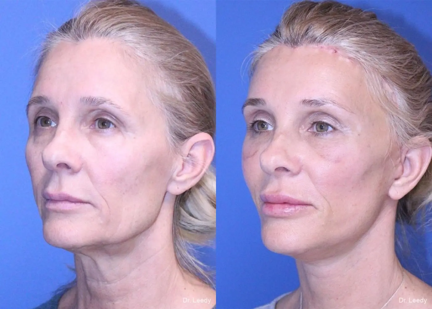Fat Grafting - Face: Patient 3 - Before and After 6