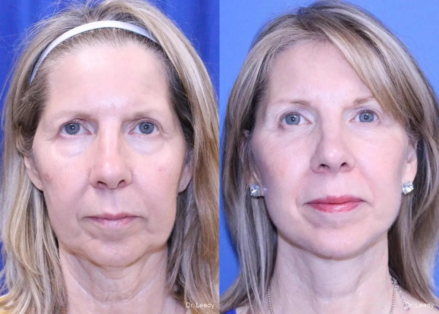 Fat Grafting - Face: Patient 5 - Before and After  