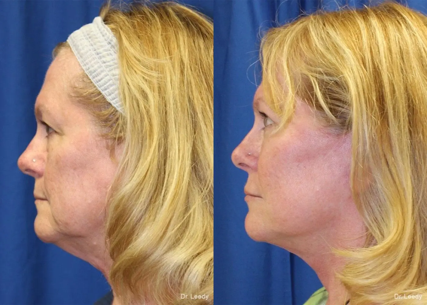 Fat Grafting - Face: Patient 1 - Before and After 5