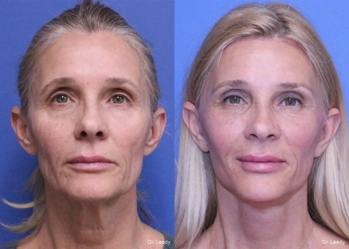 Fat Grafting - Face: Patient 3 - Before and After  