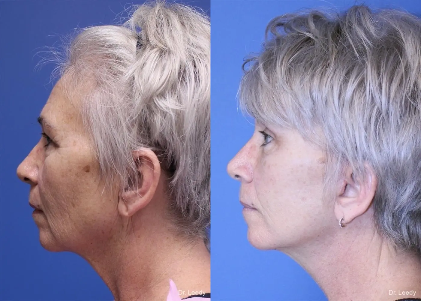Fat Grafting - Face: Patient 4 - Before and After 5