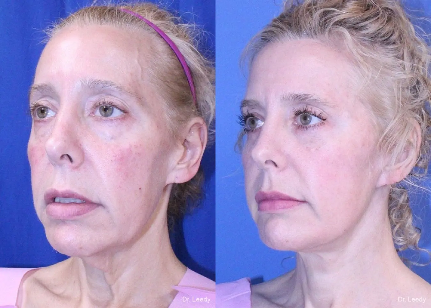 Fat Grafting - Face: Patient 2 - Before and After 4