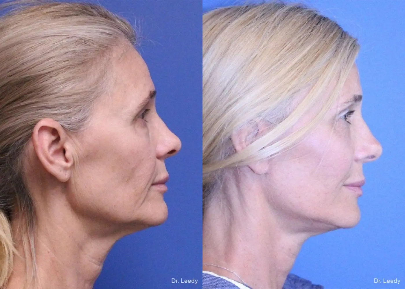 Fat Grafting - Face: Patient 3 - Before and After 2