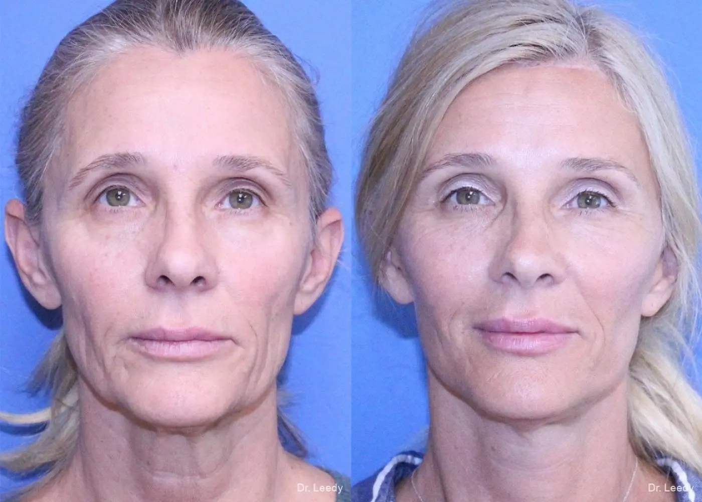 Fat Grafting - Face: Patient 3 - Before and After 3