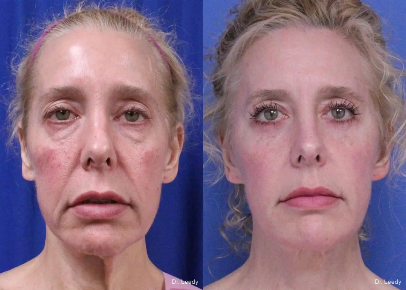 Fat Grafting - Face: Patient 2 - Before and After  