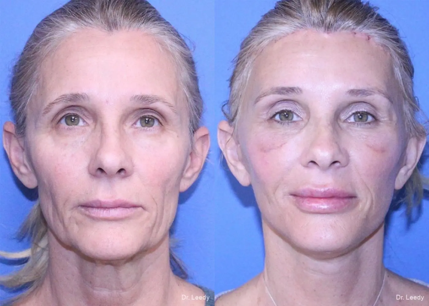 Fat Grafting - Face: Patient 3 - Before and After 5