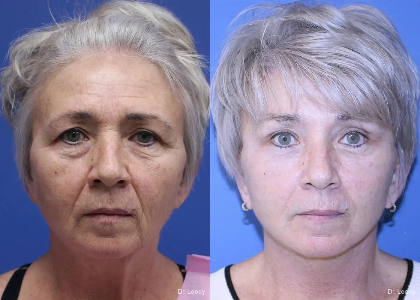 Fat Grafting - Face: Patient 4 - Before and After  