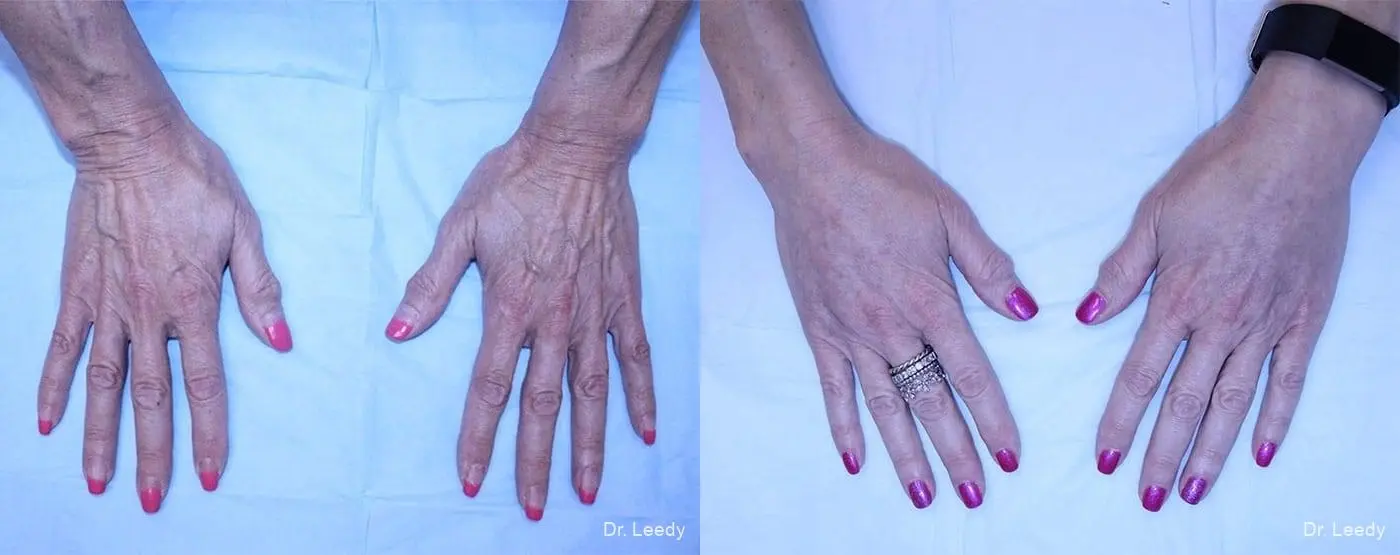 Fat Grafting - Hands: Patient 1 - Before and After 1