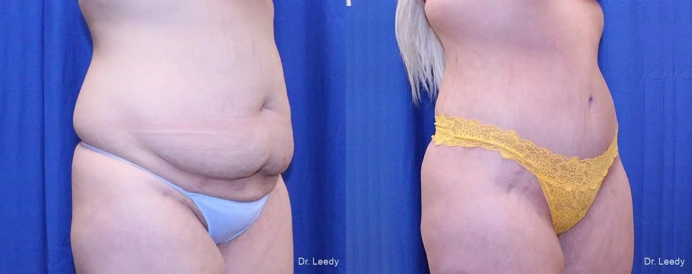 Fat Transfer - Body: Patient 3 - Before and After 2