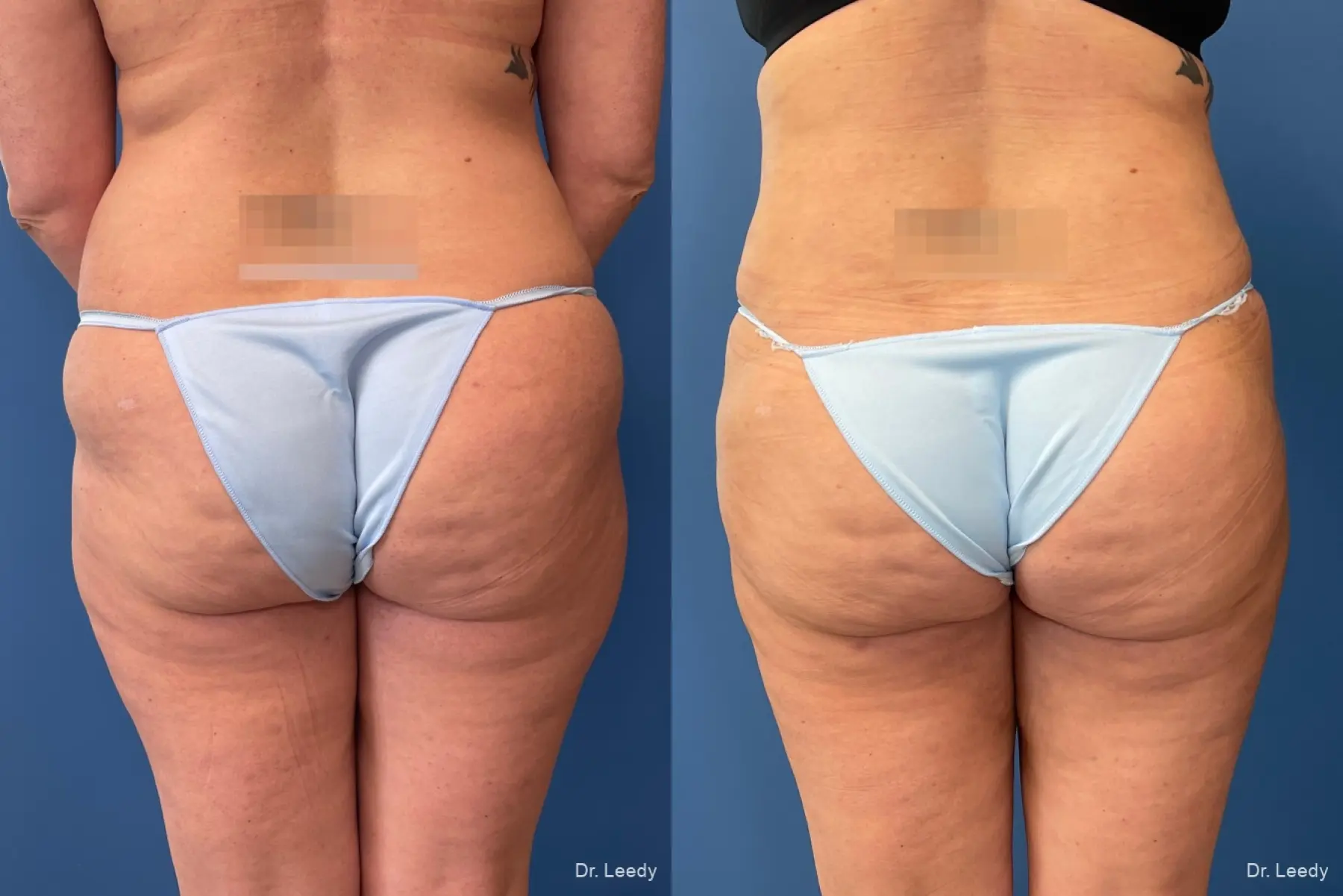 Fat Transfer - Body: Patient 4 - Before and After  
