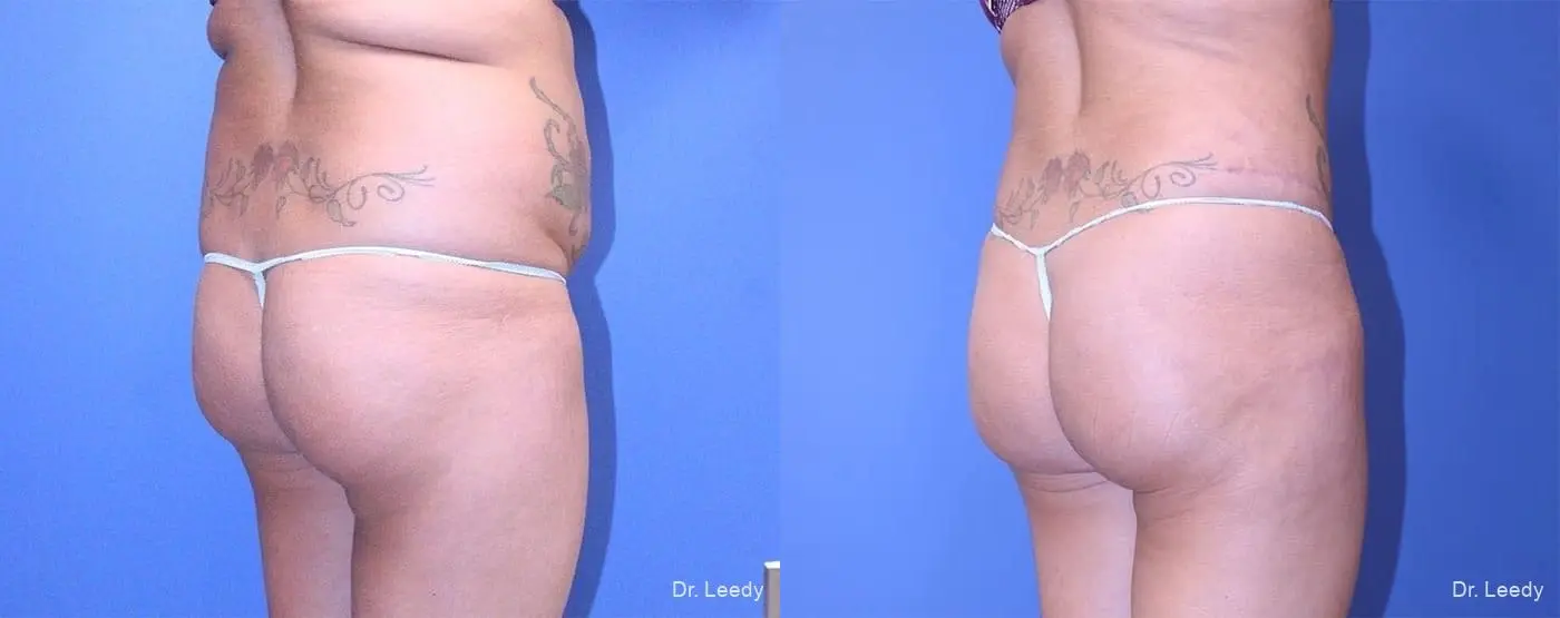 Fat Transfer - Body: Patient 2 - Before and After 3