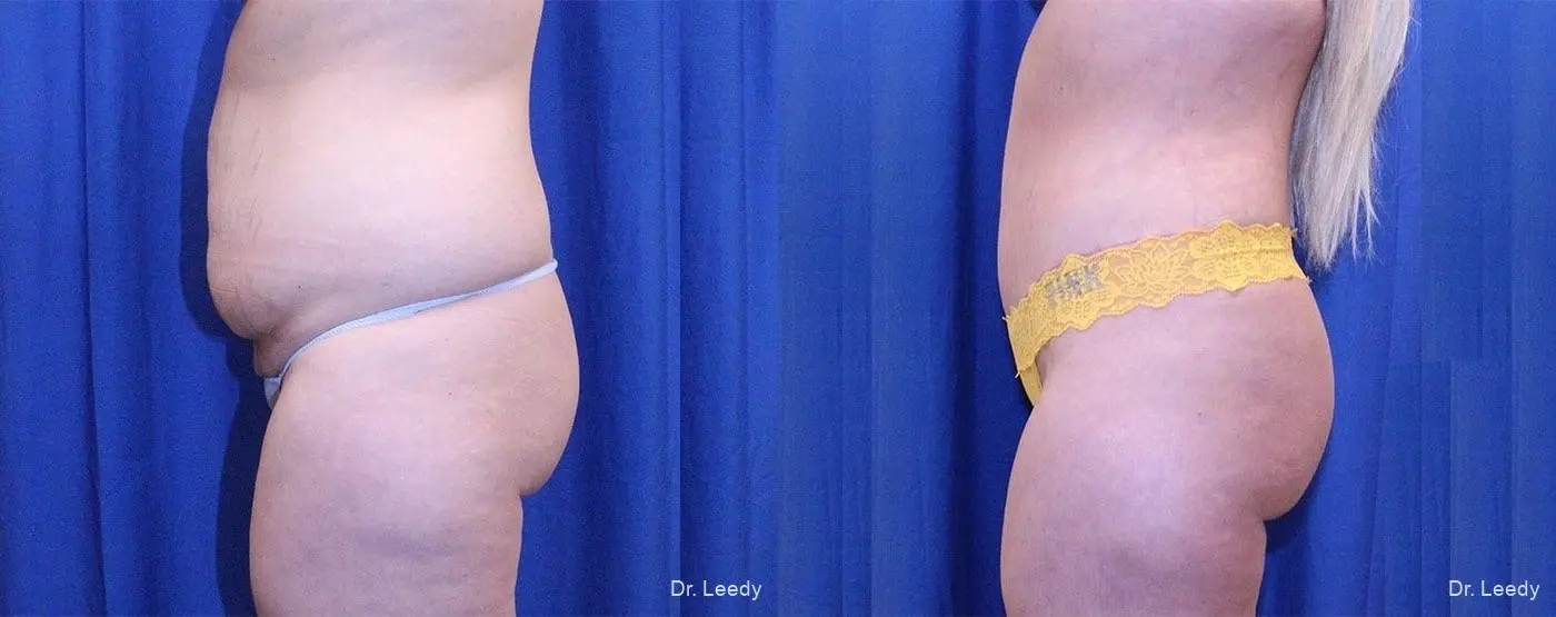 Fat Transfer - Body: Patient 3 - Before and After 5
