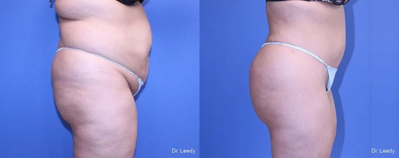Fat Transfer - Body: Patient 1 - Before and After 3
