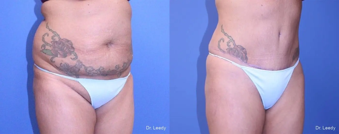 Fat Transfer - Body: Patient 2 - Before and After 2