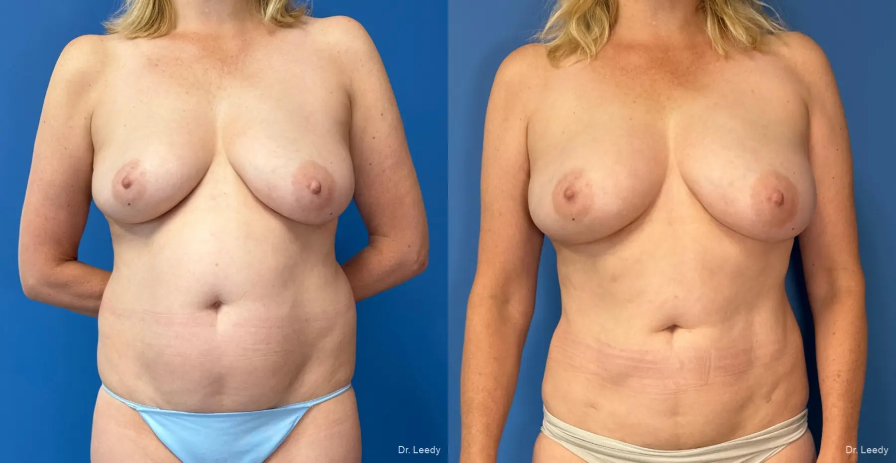 Fat Transfer - Body: Patient 6 - Before and After  