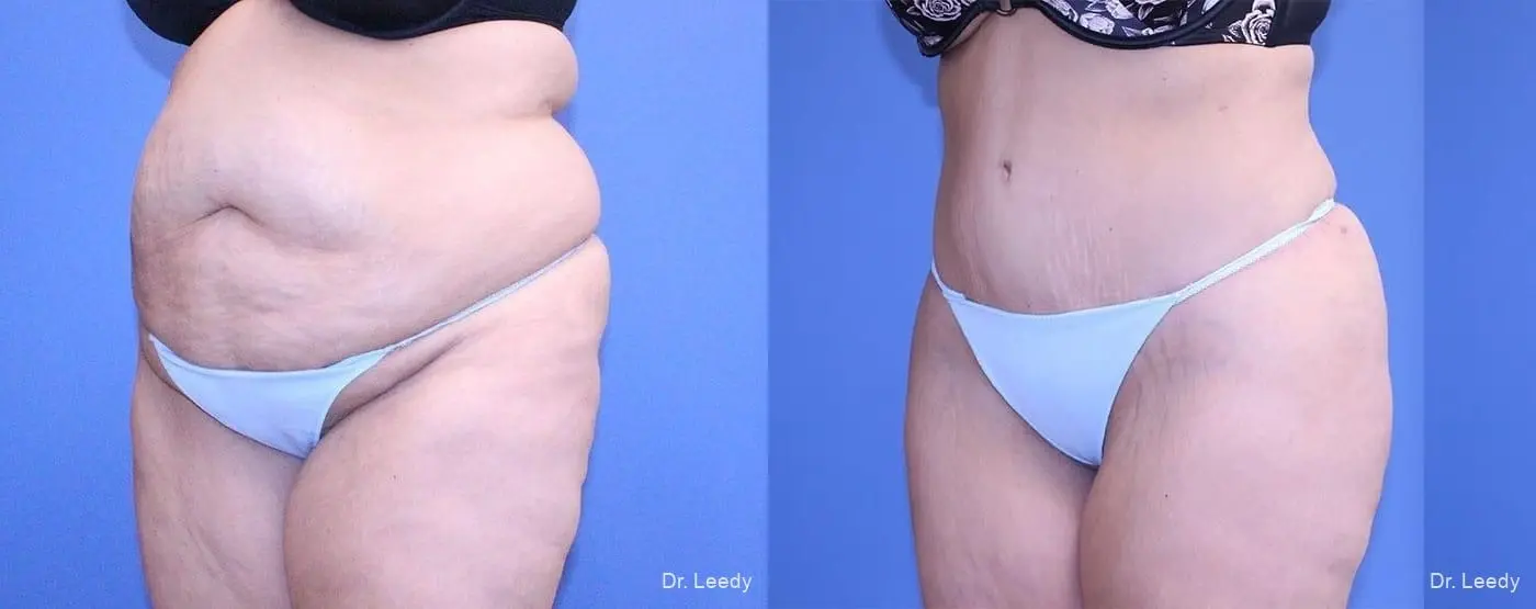 Fat Transfer - Body: Patient 1 - Before and After 4