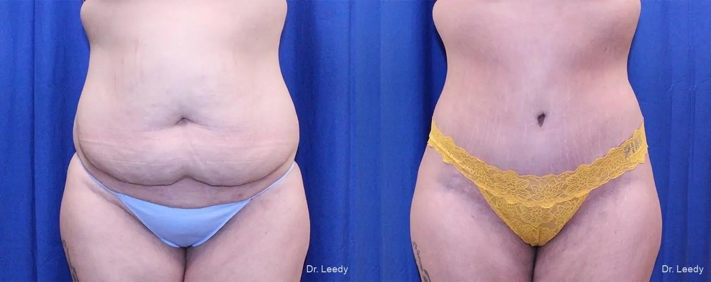 Fat Transfer - Body: Patient 3 - Before and After  