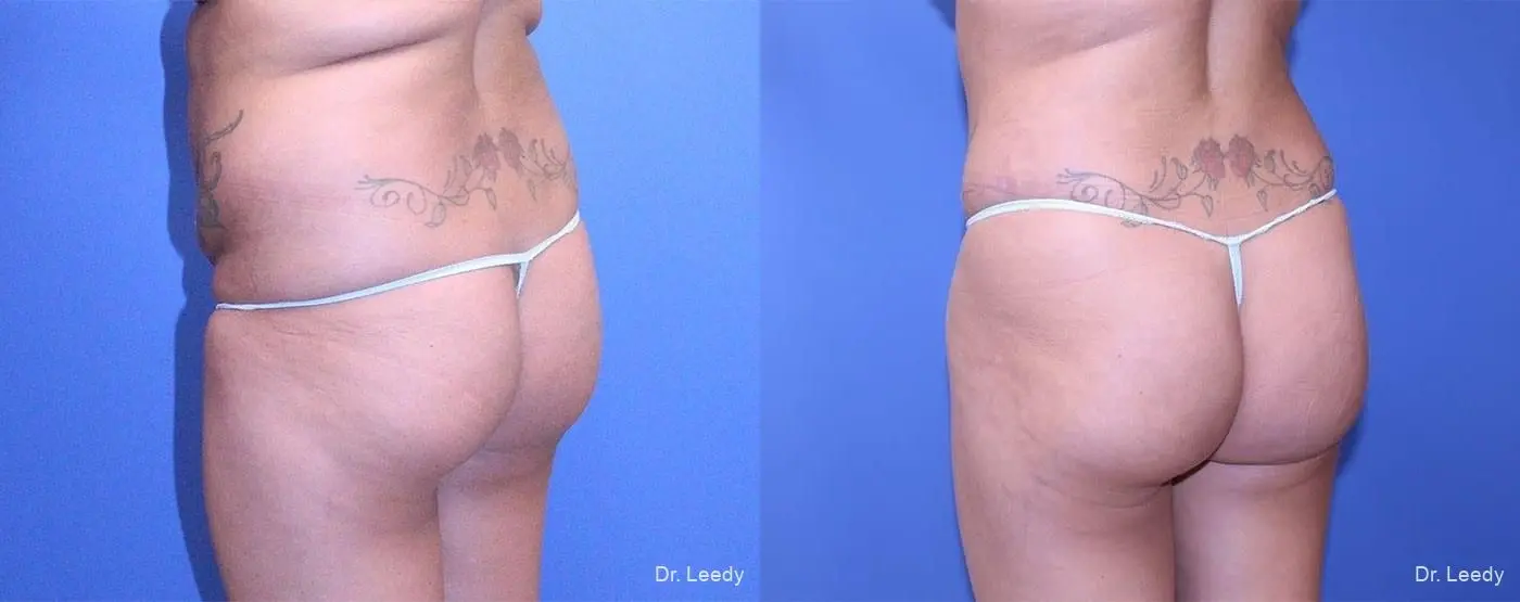Fat Transfer - Body: Patient 2 - Before and After 5