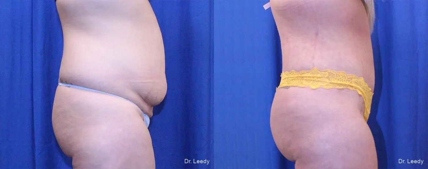 Fat Transfer - Body: Patient 3 - Before and After 3