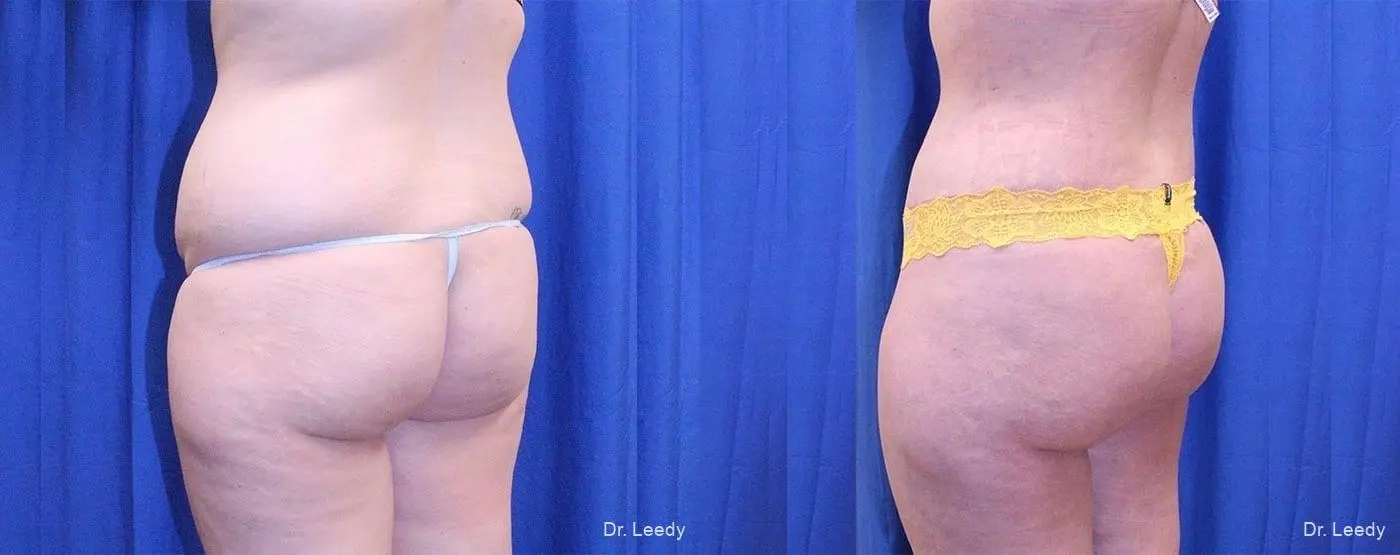 Fat Transfer - Body: Patient 3 - Before and After 4