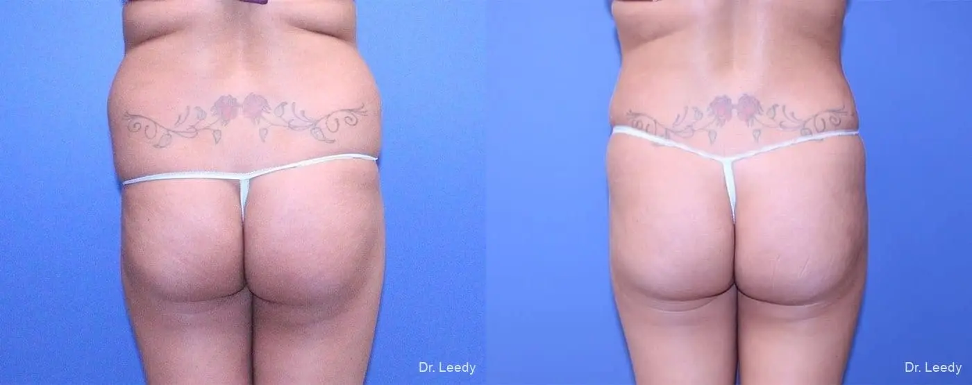 Fat Transfer - Body: Patient 2 - Before and After 7