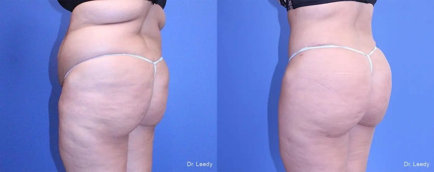 Fat Transfer - Body: Patient 1 - Before and After 5