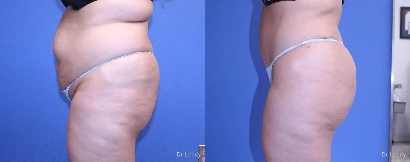 Fat Transfer - Body: Patient 1 - Before and After 6