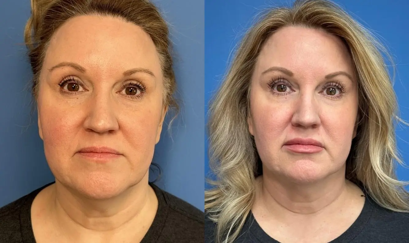 Fillers: Patient 4 - Before and After  