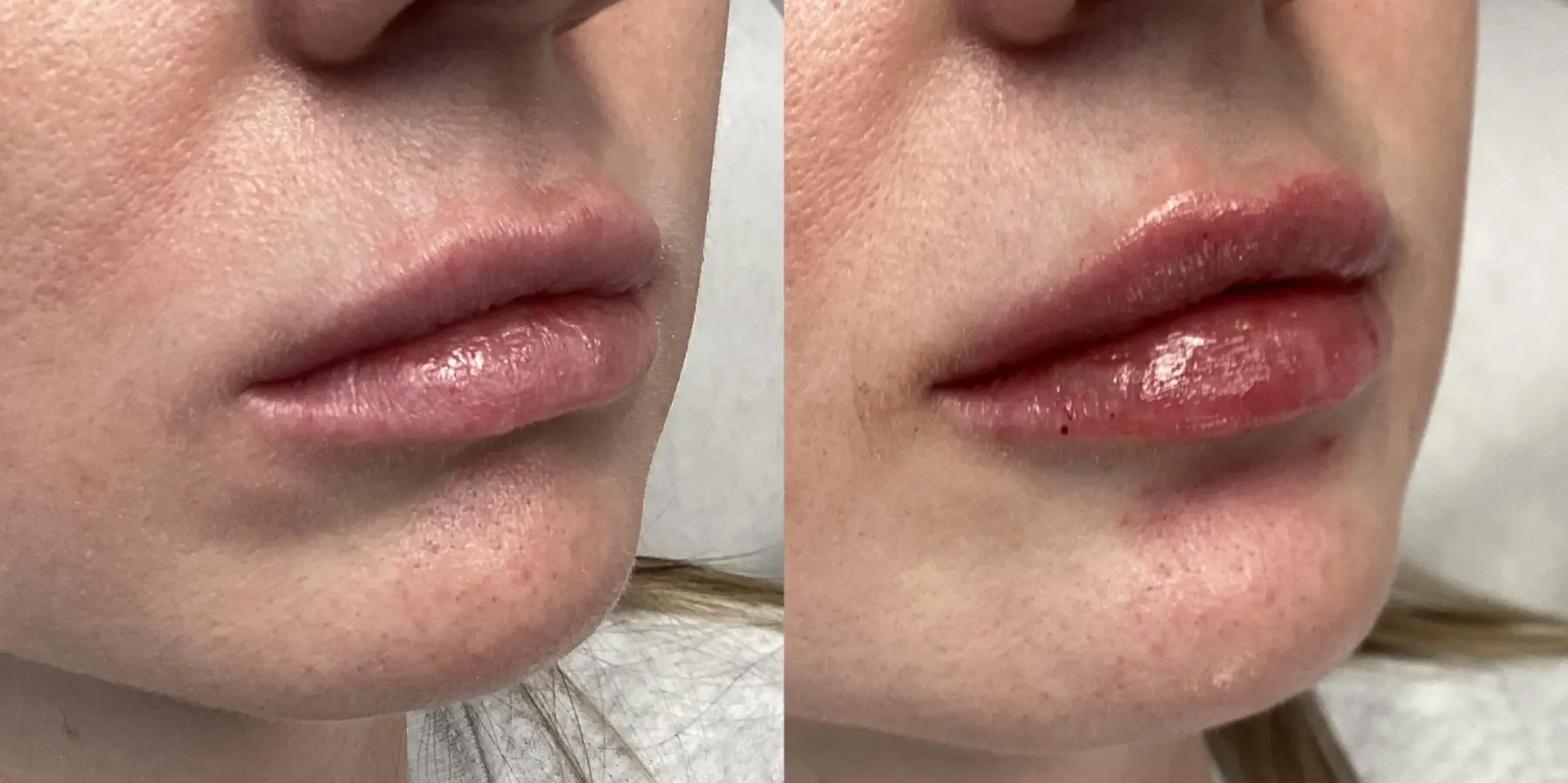 Fillers: Patient 9 - Before and After  