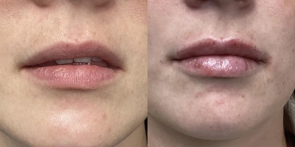 Fillers: Patient 9 - Before and After 1