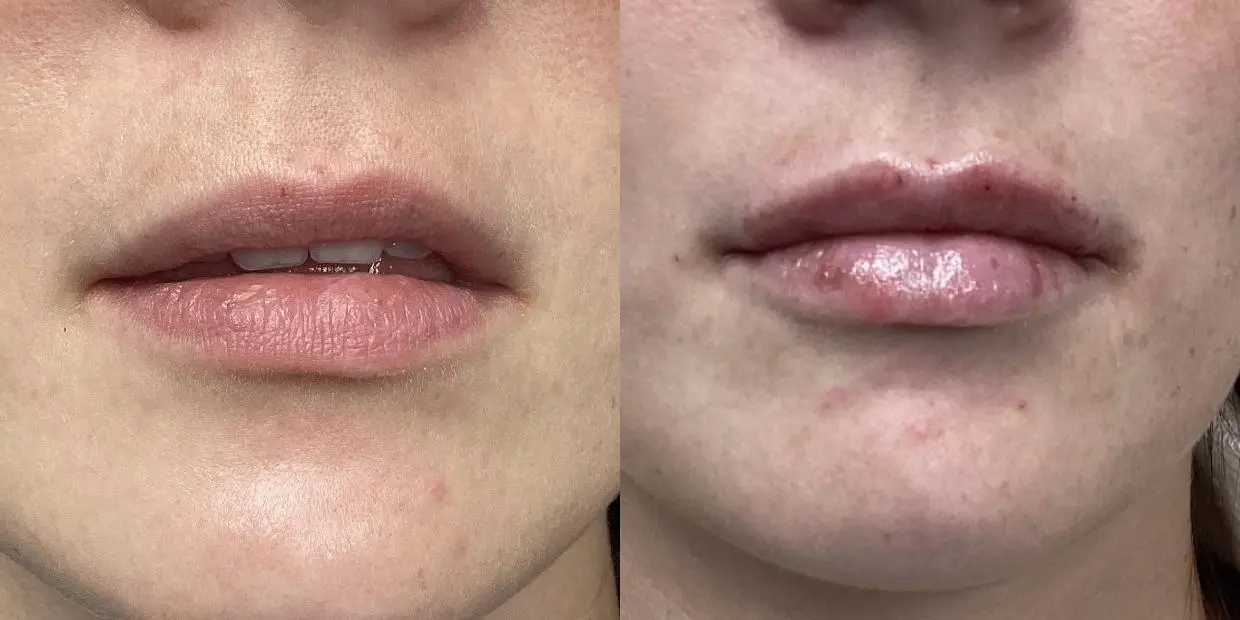Fillers: Patient 13 - Before and After  