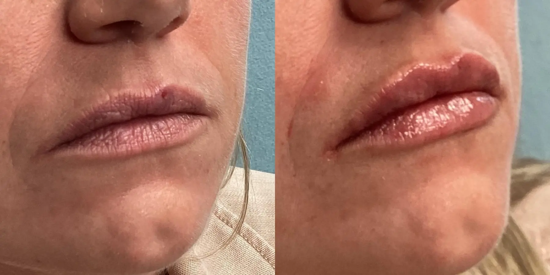 Fillers: Patient 7 - Before and After 1