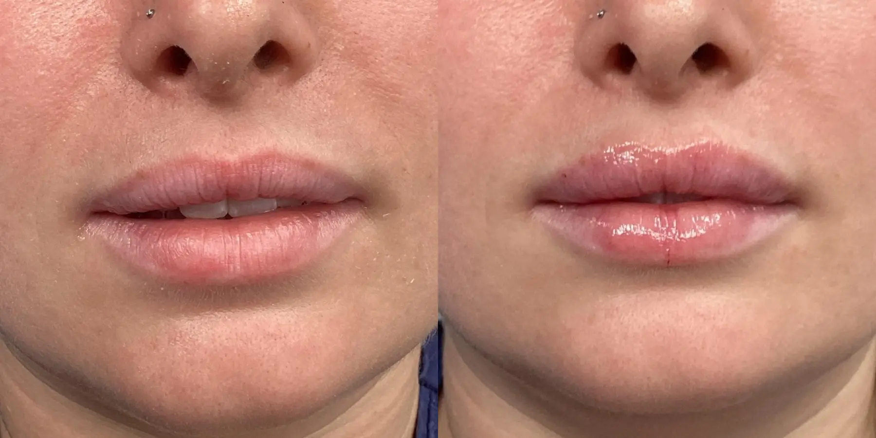 Fillers: Patient 8 - Before and After  