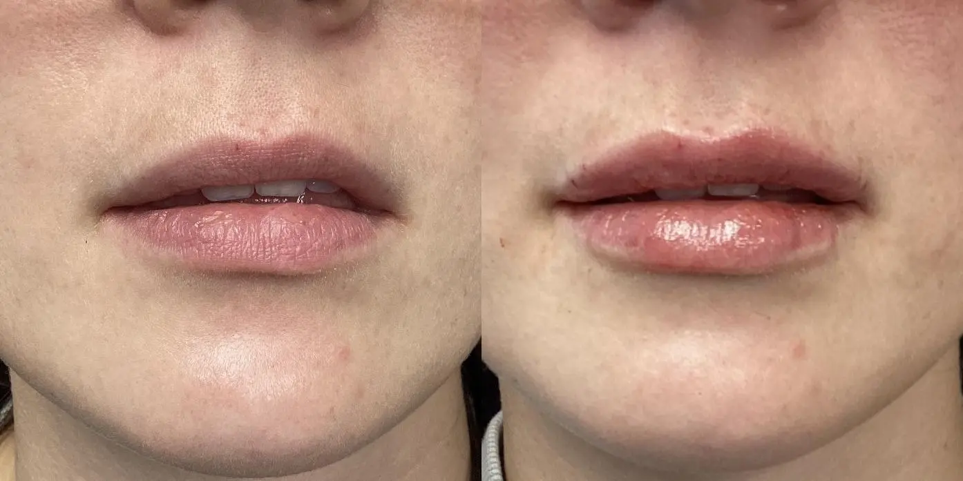 Fillers: Patient 8 - Before and After  