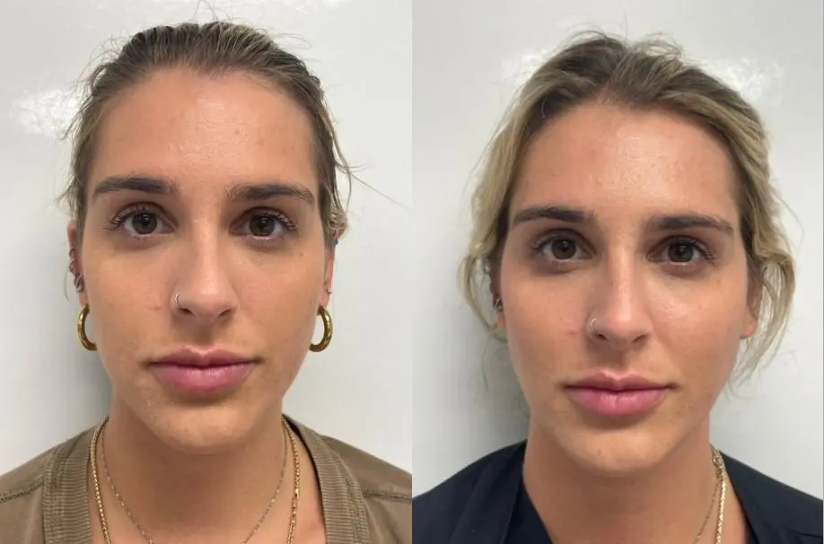 Fillers: Patient 1 - Before and After  