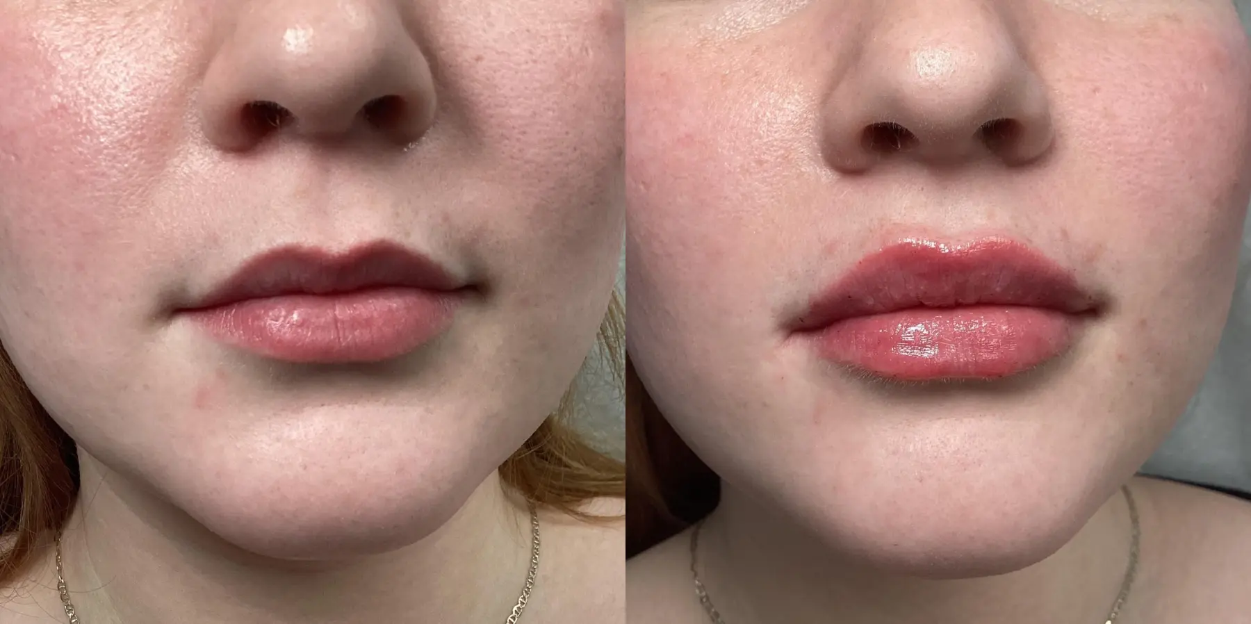 Fillers: Patient 6 - Before and After  