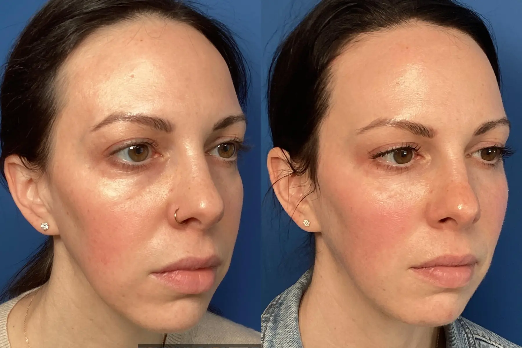 Fillers: Patient 7 - Before and After  