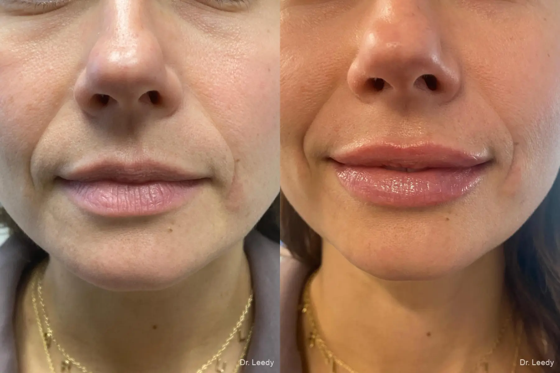 Fillers: Patient 4 - Before and After  