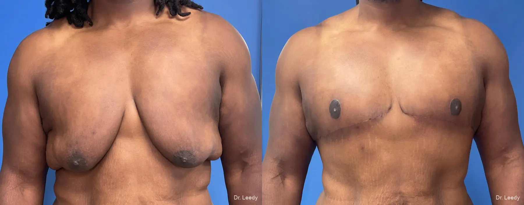 Gynecomastia: Patient 8 - Before and After  