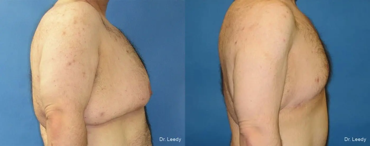 Gynecomastia: Patient 3 - Before and After 3