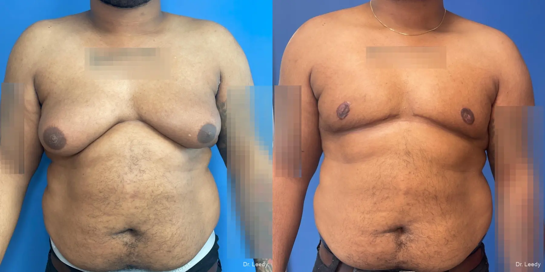 Gynecomastia: Patient 4 - Before and After  