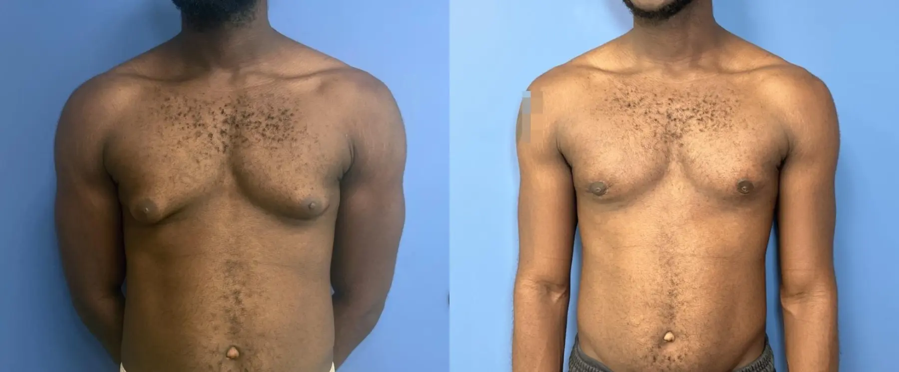 Gynecomastia: Patient 1 - Before and After  