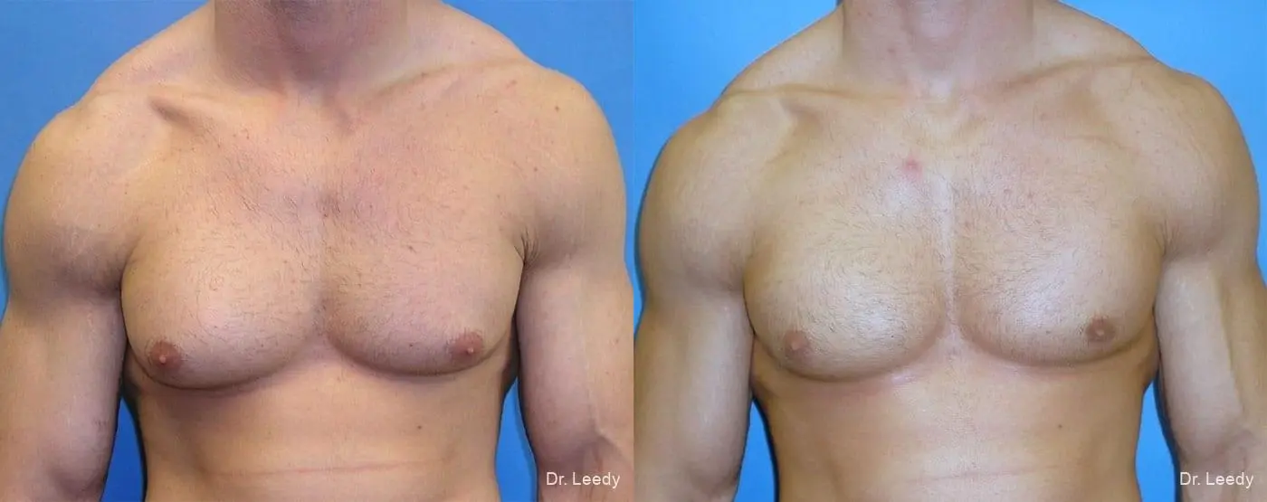 Gynecomastia: Patient 2 - Before and After  