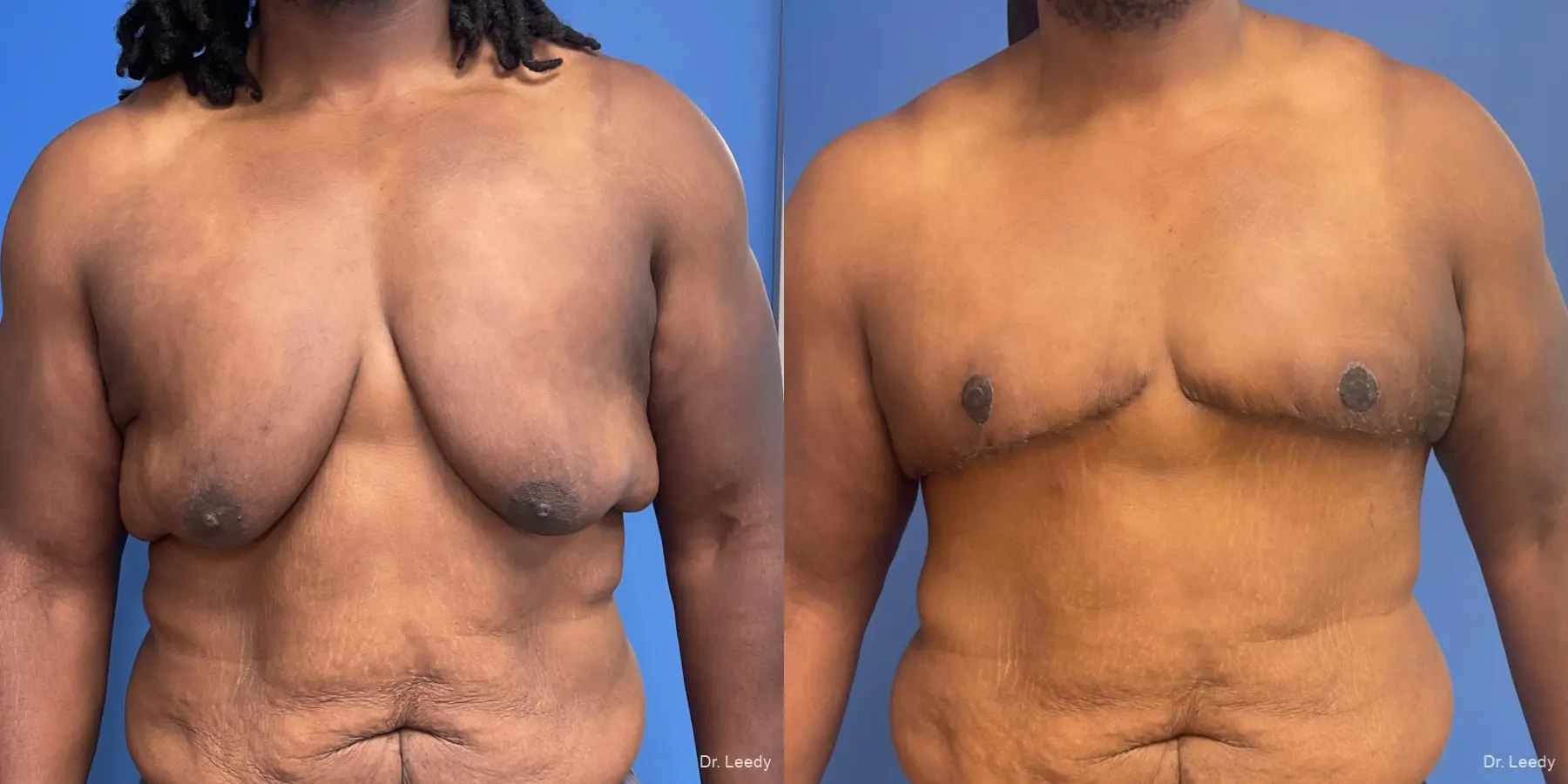 Gynecomastia: Patient 5 - Before and After  
