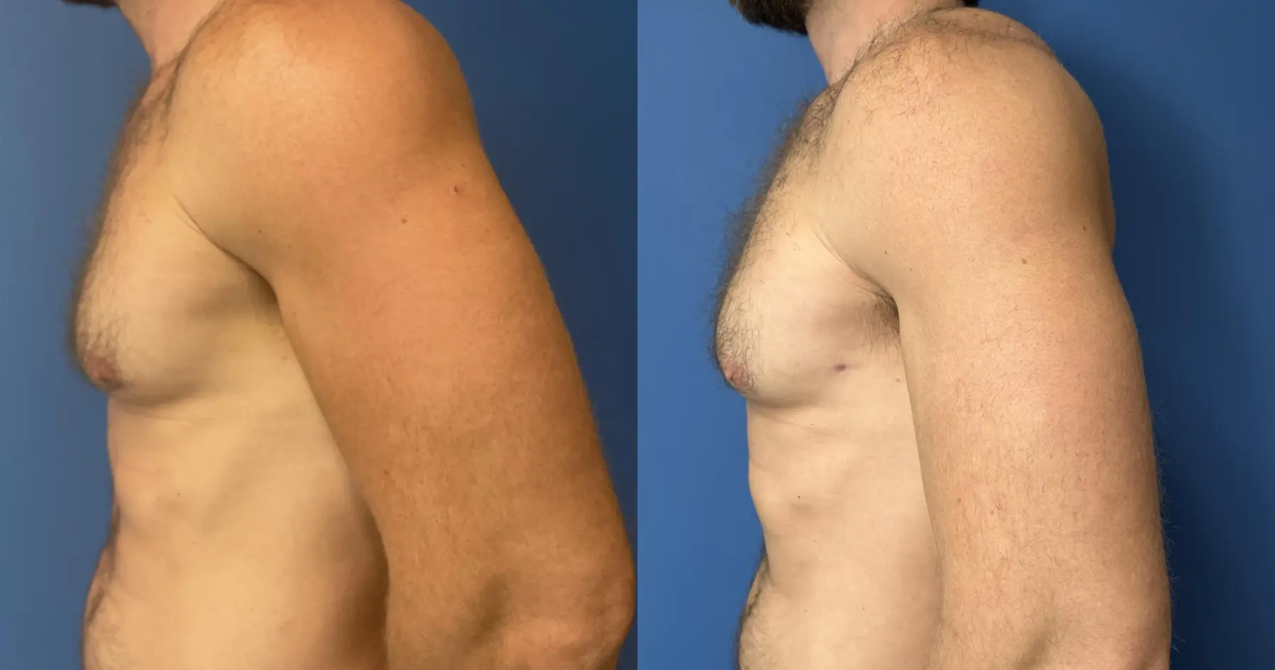 Gynecomastia: Patient 6 - Before and After  