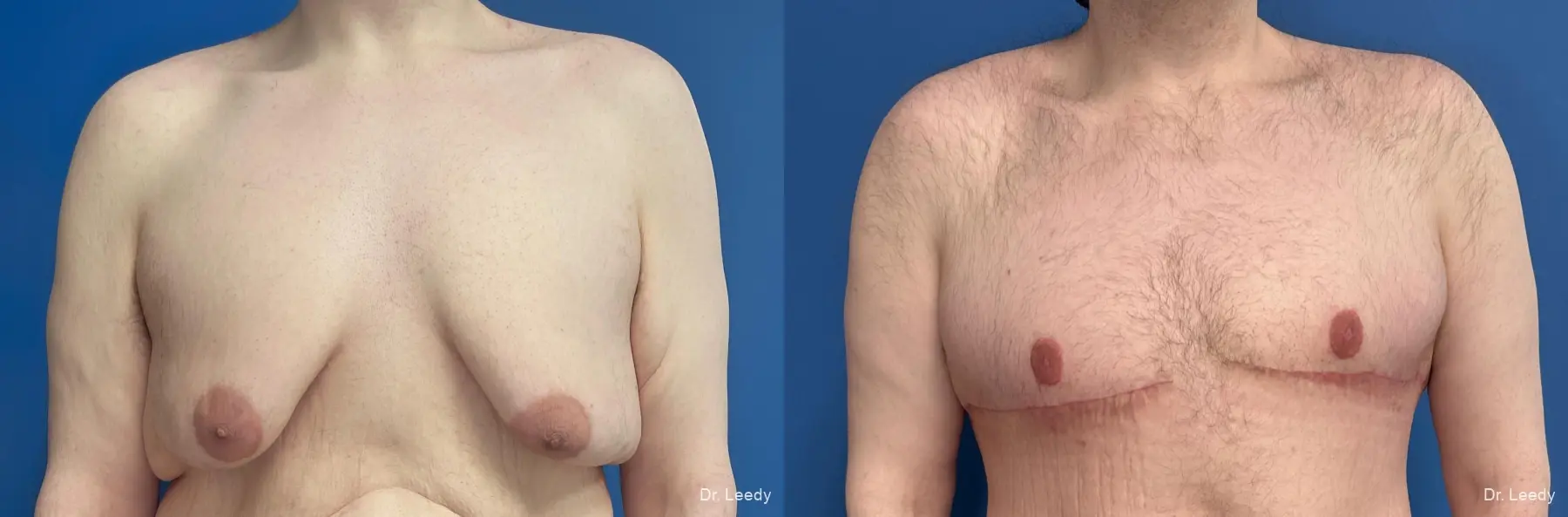 Gynecomastia: Patient 7 - Before and After  