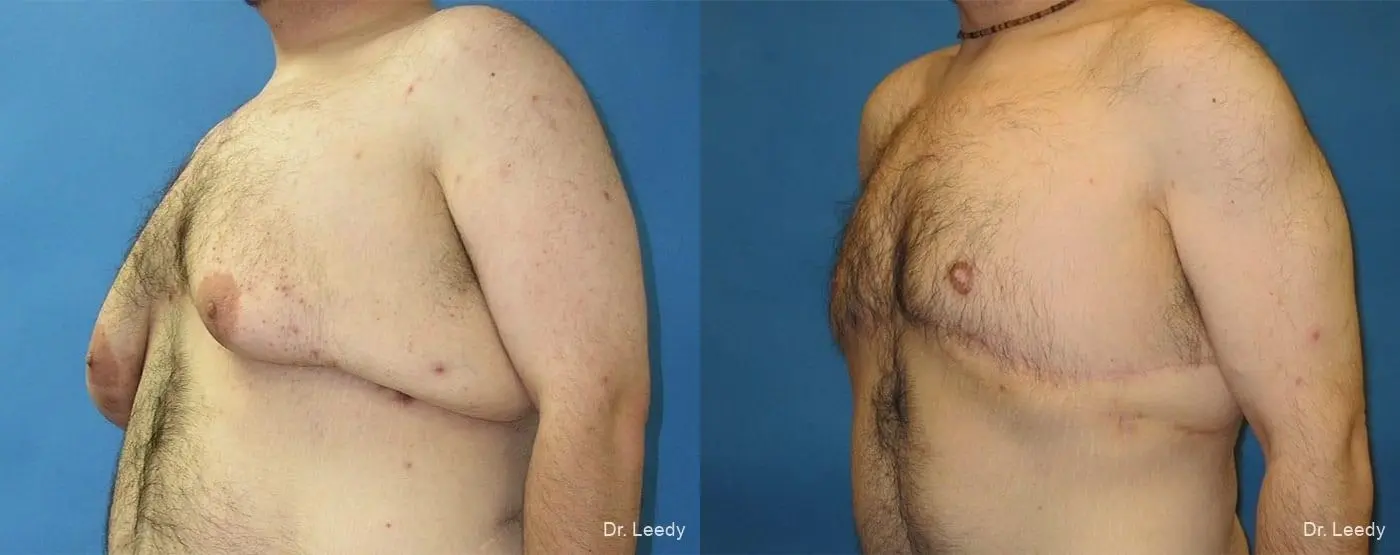 Gynecomastia: Patient 3 - Before and After 4