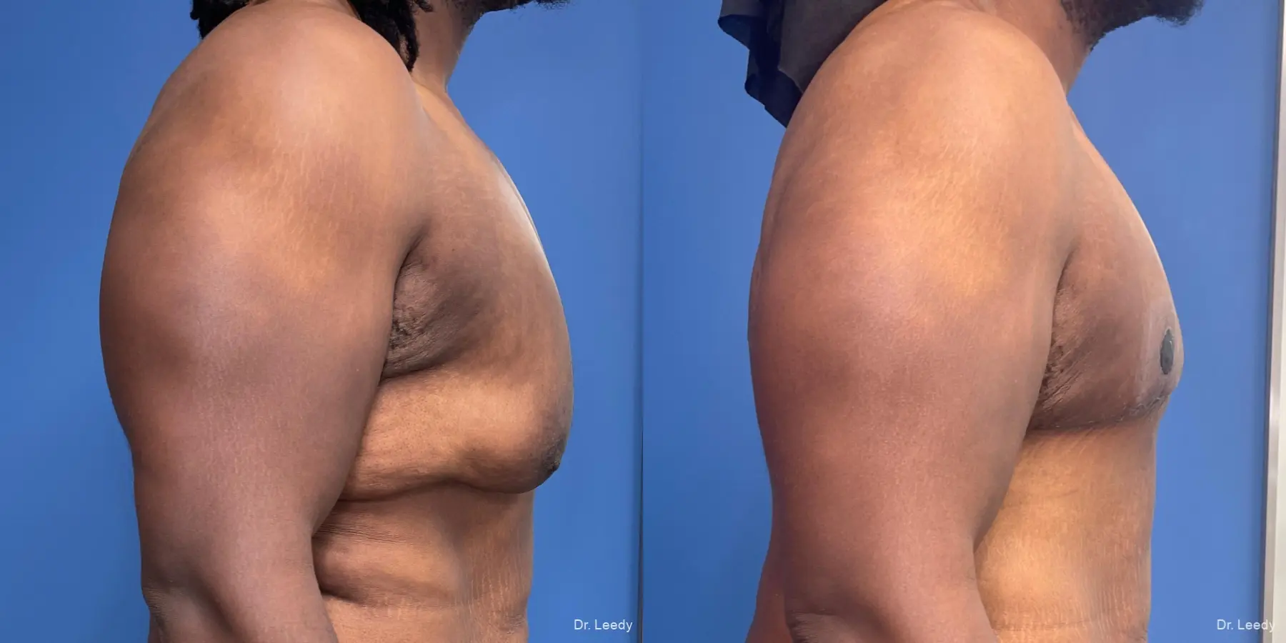 Gynecomastia: Patient 5 - Before and After 3
