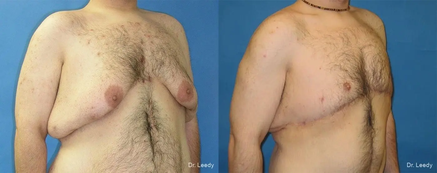 Gynecomastia: Patient 3 - Before and After 2