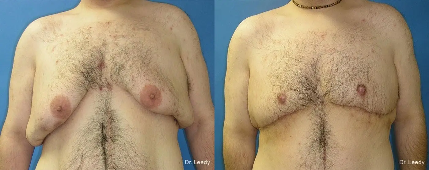 Gynecomastia: Patient 3 - Before and After  